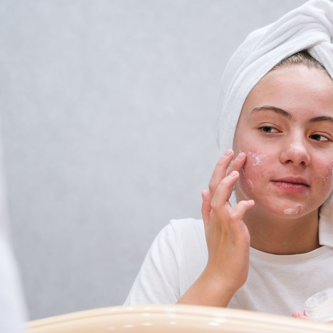 Acne Treatment Singapore: Is it good for your Skin?