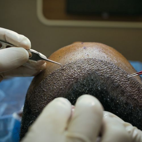 Hair Transplant