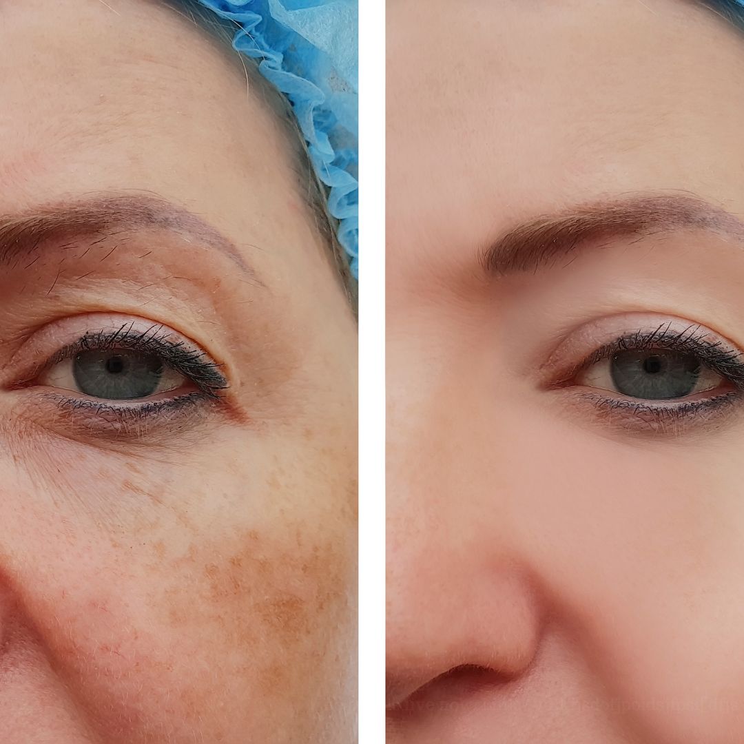 Pigmentation Removal