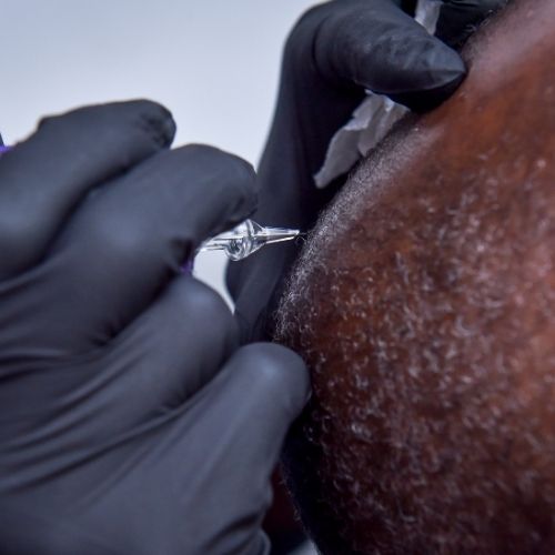 What Is Scalp Micropigmentation?