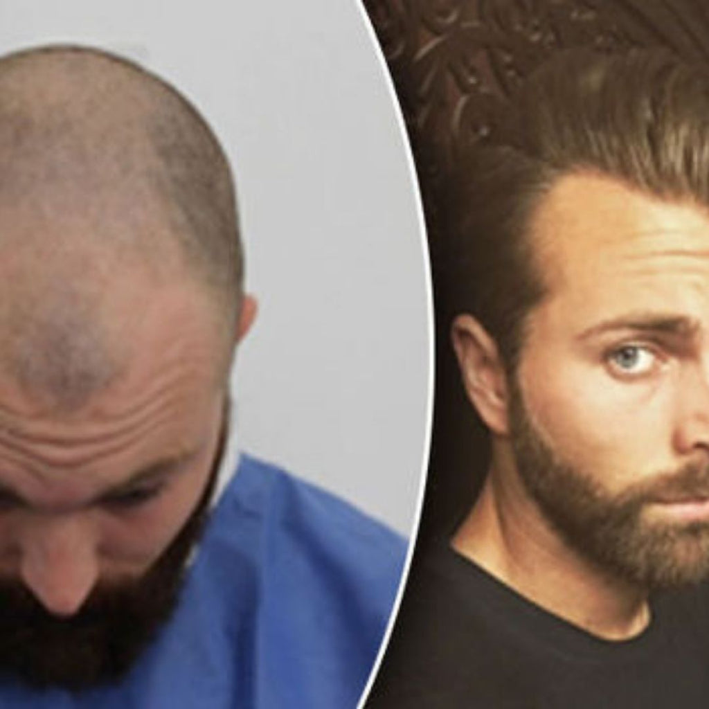 What to expect after a hair transplant?