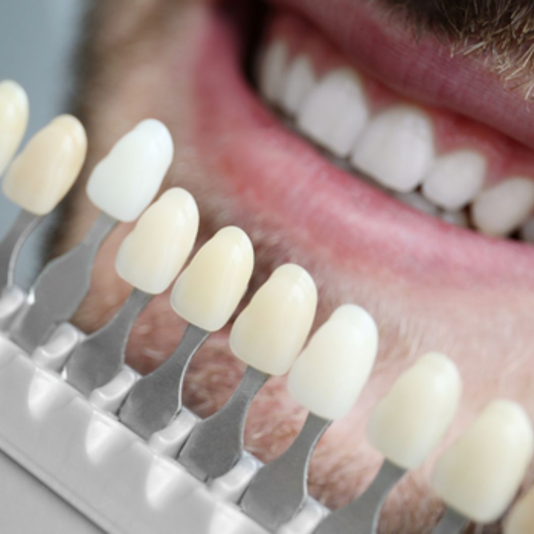 porcelain veneers