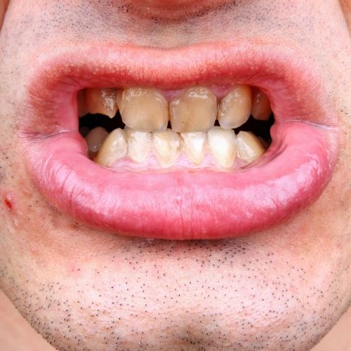 Home Remedies For Tooth Stains