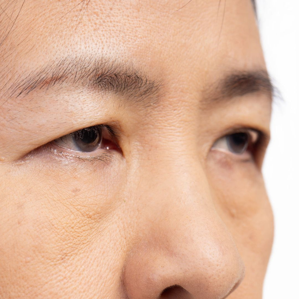 Exploring Non-Surgical and Surgical Treatment Options for Droopy Eyelids in Singapore